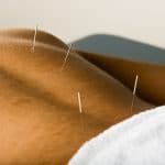 man getting acupuncture treatment for back pain