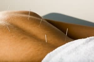 man getting acupuncture treatment for back pain